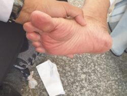 7 Tips Cegah Tapak Kaki Melepuh saat Ibadah Haji
